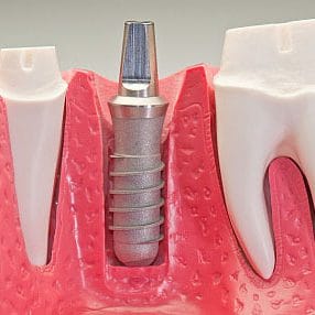 implant1 implant1