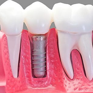 implant2 implant2