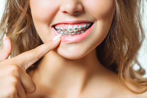 Orthodontic Treatment. Dental Care Concept. Beautiful Woman Healthy Smile close up. Closeup Ceramic and Metal Brackets on Teeth. Beautiful Female Smile with Braces